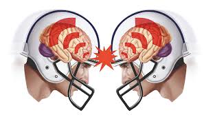 Visual image of reaction when 2 helmets collide in football.

